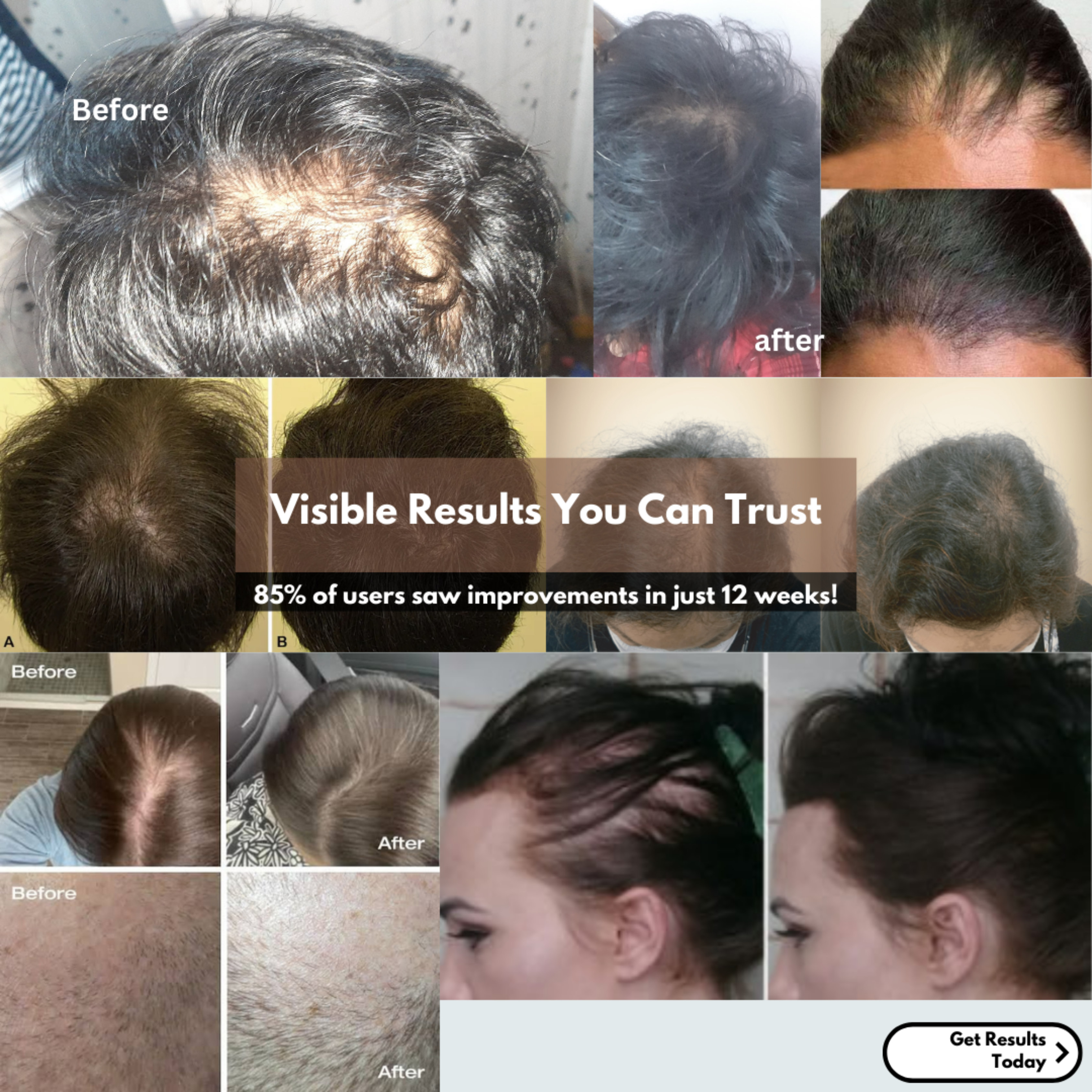 Rextra Series Elixir | Proven with Redensyl, Procapil, Anagain & Biotin | 50 ml